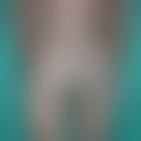 Lepra (Übersicht): Lepra lepromatosa B (Boderline Typ) mit großflächigen deutlich infiltrierten, ...