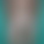 Leprosy lepromatosa: Leprosy lepromatosa B (Boderline type) with large-area clearly infiltrated, ...
