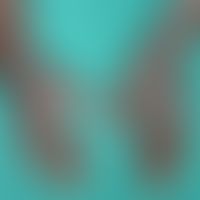 Lepra lepromatosa:&nbsp;fortgeschrittener Befund mit &nbsp;zahlreichen , nahezu symmetrisch verte...