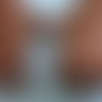 Leprosy lepromatosa: Stiffening ofthe fingers in a claw-like position; closure of the fist no lon...