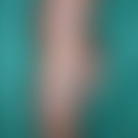 Dimorphic leprosy of the lepromatous type: borderline leprosy  of the lepromatous type with multi...