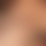 Lichen planus actinicus:&nbsp;Melasma-Form mit flächigen, braun-schwarze Flecken.
