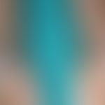 Lichen plaLichenplanus classic type: for several months, itchy, polygonal, partially confluent, s...