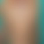 Lichen striatus: verrucous lichen planus that has been present for several months and follows the...