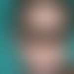 Molluscum contagiosum: extensiver Befall&nbsp;&nbsp;des Gesichts bei bekannter HIV-Infektion.
