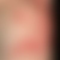 Dermatitis kontaktallergische: Akut aufgetretene, großflächige, rote Flecken und Plaques mit raue...