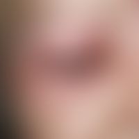 Dermatitis kontaktallergische: Multiple (beide Lidregionen betroffen), akute, unscharf begrenzte,...