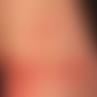 Acute contact allergic dermatitis with scattering reaction after application of a gel containing ...