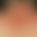 Dermatitis&nbsp;photoallergische:&nbsp;seit&nbsp; 6 Wochen unangenehm juckende und spannende Haut...