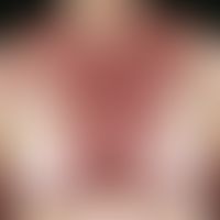 Eczema, photoallergic. 78-year-old female patient. Taking diuretics because of lymphedema. After ...