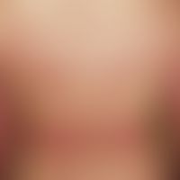 eczema, photoallergic. 51-year-old female patient. generalized skin disease with 0.2-0.4 cm large...
