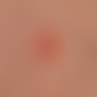 Epicutaneous test. detail enlargement: positive type IV reaction in a 47-year-old patient against...