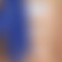 Epicutaneous test: Type IV reaction in a 41-year-old female patient against components of latex-f...