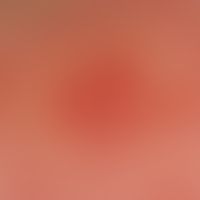 Epicutaneous test: Angry back with overshooting local reaction. Patch reaction. Readout after 48 ...