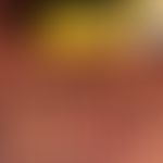 Epikutantest. Positive Testreaktion auf eine Bufexamac-haltige Salbe.
