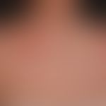 Angry back: Multiple "falsch positive" und klinisch nicht relevante Testreaktionen bei Epikutante...