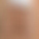 Epikutantest: Nickeltitrationsreihe
