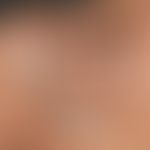 Epikutantest:Mehrere positive Testreaktionen. Ablesezeit 72 Stunden.
