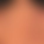 Epikutantest:&nbsp;Titrierungsreihe
