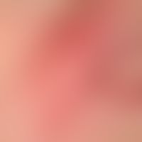Erysipel: akut aufgetretene, unscharf begrenzte, flächige Rötung und Schwellung, rechts nasal und...