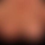 Erysipelas, recurrent with pronounced lymphedema (see protruding follicle structure).
