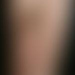 Erythema e calore. reticular erythema caused by frequent use of a heating pad with distinct hyper...