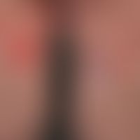 Livedo reticularis: marmorierte Haut mit symmetrischen, nur bei Kälte in Erscheinung tretenden, b...