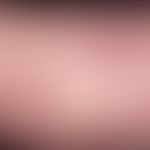 Livedo racemosa. Bizarrely configured, nonpainful erythema bands. Partially incomplete ring struc...