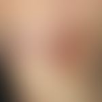 Livedo racemosa: Livid and brownish-red, lightning figure-like stripes and nets on the sole of th...