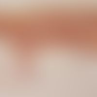 Livedo racemosa: section through the skin (cross section through striated erythema). vessel compl...