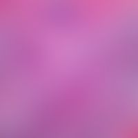 Livedovasculopathy: Tissue sample from peripheral area. The entire dermis, with accentuation of t...