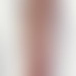 Lymphangitis acuta. red, pressure-painful, palpable strand on the right forearm in the course of ...