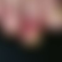 Pernio. red spots and smooth red plaques which are not very conspicuous in the symptom-free inter...