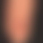 Pernio. Perniones, schmerzhafte bei Kälte rezidivierende Frostbeulen bei bekanntem (idiopathische...