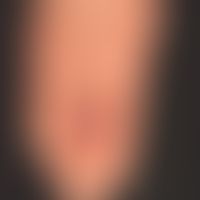 Pernio. perniones, painful frostbite recurring in the cold with known (idiopathic) Raynaud's synd...