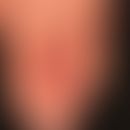 Pernio. perniones, painful frostbite recurring in the cold with known (idiopathic) Raynaud's synd...