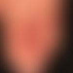 Pernio. Perniones, schmerzhafte bei Kälte rezidivierende Frostbeulen bei bekanntem (idiopathische...