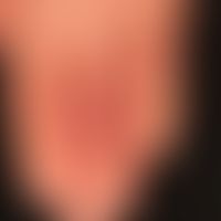 Pernio. perniones, painful frostbite recurring in the cold with known (idiopathic) Raynaud's synd...