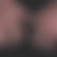 Perniones: distinct acrocyanosis of the hands. painful acral inflammation especially in the trans...