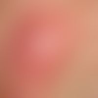 Teleangiectasia. Harmless, reticularly branched, irregular vascular dilatations in the area of bo...