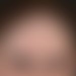 Alopezie, postmenopausale, frontale, fibrosierende:&nbsp;Übersichtsaufnahme: Ausgeprägte fronto-t...