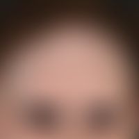 Alopezie, postmenopausale, frontale, fibrosierende:&nbsp;Übersichtsaufnahme: Ausgeprägte fronto-t...