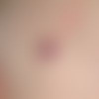 Haemangioma, capillary: clinical finding of the angioma senilis.
