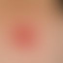 Basalzellkarzinom ulzeriertes:&nbsp;seit längerem bestehende, langsam wachsende&nbsp;schmerzlose&...