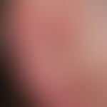 Basal cell carcinoma, nodular: Nodule existing for 3 years, completely without symptoms, size: 2....