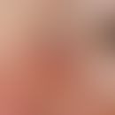 Basal cell carcinoma, cystic. 0.6 cm in diameter, slowly growing for several months, elastic, sof...