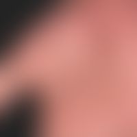 Dyshidrosis lamellosa sicca.&nbsp;40-jähriger Patient mit rezidivierenden, 0,1-0,2 cm großen, juc...