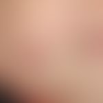 Pilomatrixom&nbsp;(Epithelioma calcificans): rötlich-brauner, kalottenförmiger, gegenüber der Unt...