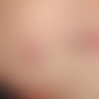 Pilomatrixom&nbsp;(Epithelioma calcificans): rötlich-brauner, kalottenförmiger, gegenüber der Unt...