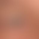 Hidrozystom:&nbsp;bei dem 57-jährigen Mann besteht seit einem Jahr eine schmerzlose, hellle, kalo...